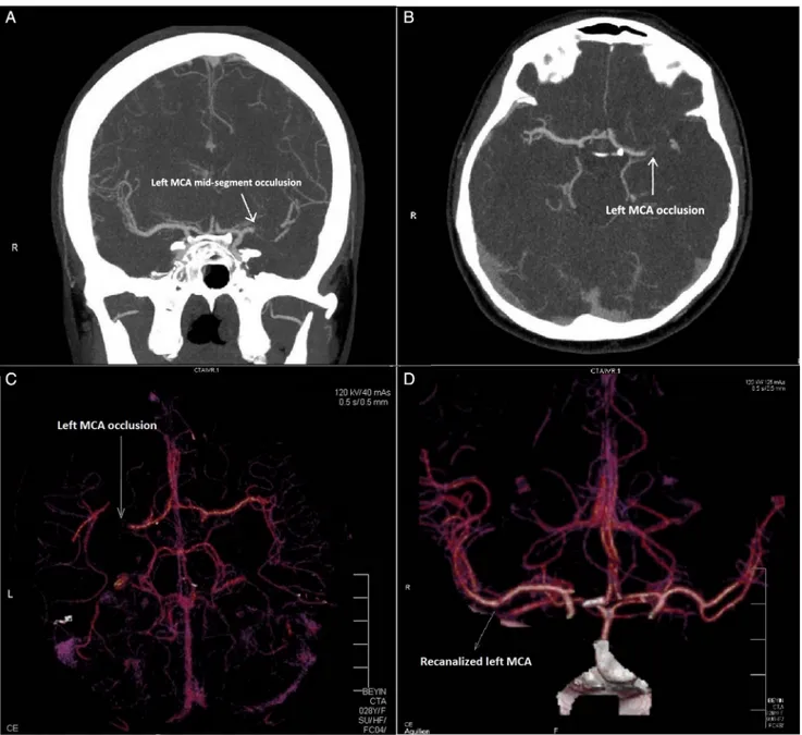 Fig. 2. Cerebral multidetector computed tomography (MDCT) angiography revealed thrombotic occlusion of left middle cerebral artery (MCA) without any sign of hemorrhage (A–C)