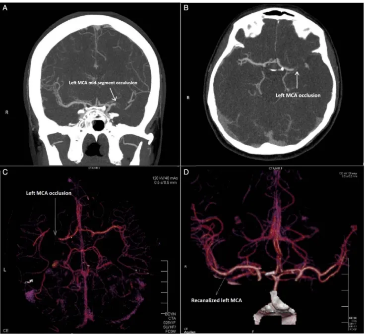Fig. 2. Cerebral multidetector computed tomography (MDCT) angiography revealed thrombotic occlusion of left middle cerebral artery (MCA) without any sign of hemorrhage (A–C)