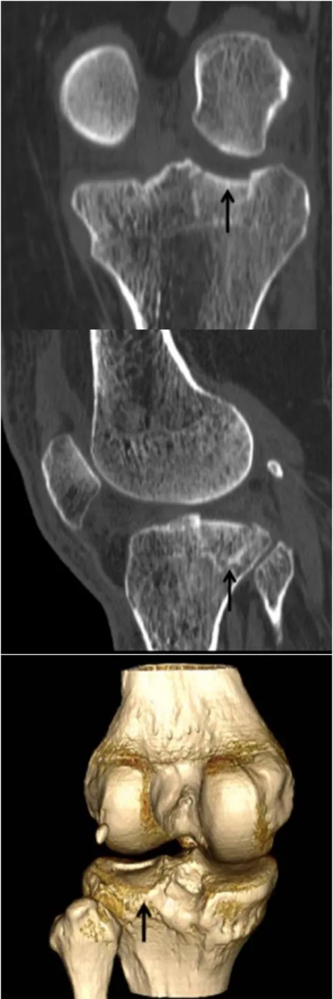 Şekil 1. Koronal (a) ve sagittal (b) reformat ve  3B VR (c) görüntülerde sol tibiada lateral plato  kırığında kompresyonun miktarı da  değerlen-dirilebilmektedir (oklar)