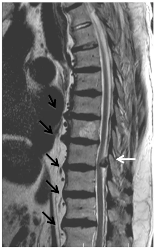 Şekil 2: Ön-arka lomber vertebral grafide  sindesmofitler ve normal ön-arka sakroiliak  ve kalça eklemi 