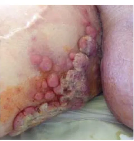 Figure 2. Patient's Skin Lesion 