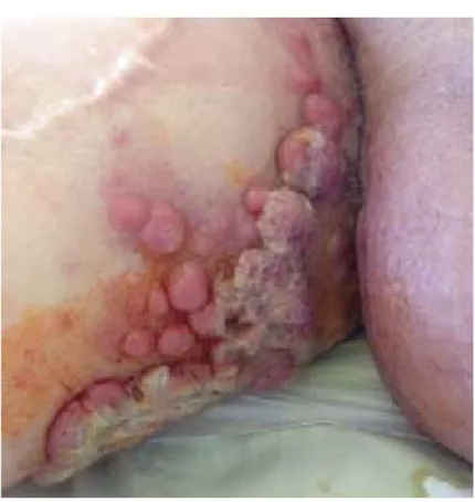 Figure 2. Patient's Skin Lesion 
