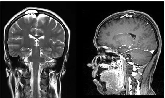Şekil 2: Lezyonun gösterildiği sagittal ve koronal magnetik rezonans görüntüleme kesitleri