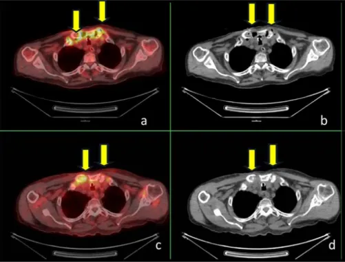 Figure 1. Axial CT and fusion slices of PET/CT at the level of uppe rmediastinum before  treatment