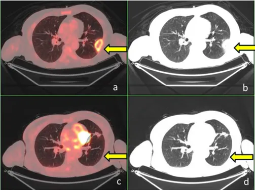 Figure 2. Axial CT and fusion slices of PET/CT on lung window setting before treatment