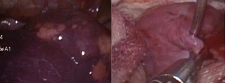 Figure 1: Thoracoscopic cystostomy  