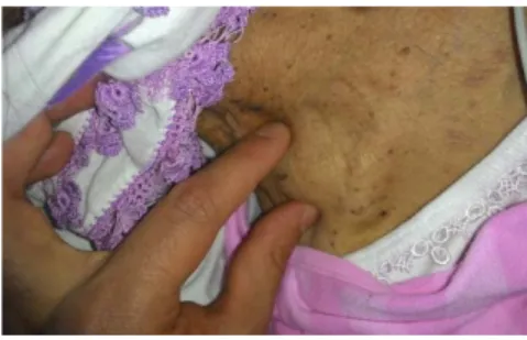 Figure 1:  Physical examination revealed a  pulsatile mass measuring nearly 3x3 cm in the  right supraclavicular region 