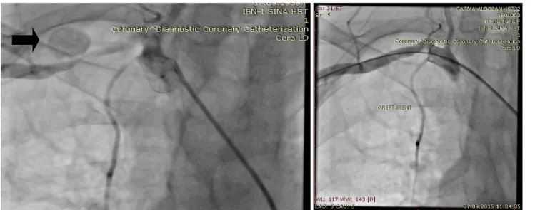 Figure 2: Selective angiography of the right SCA confirmed the 