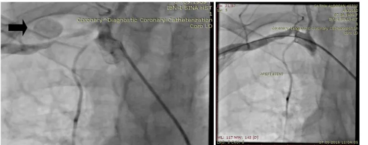 Figure 2: Selective angiography of the right SCA confirmed the 