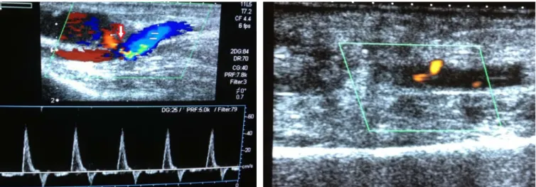 Figure 1: Arrow indicates 17x10 mm sized pseudoaneurysm with a 