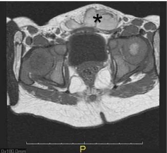 Figure 1: Magnetic resonance imaging scans showing the mass with asteriks 