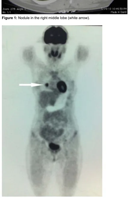 Figure 2: PET scan image – nodule in the lung (white arrow). Chest CT was performed and a 18 mm 
