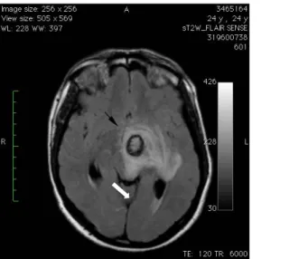 Figure  4: Metastatic lesion in the left cerebellar hemisphere (black arrow). 