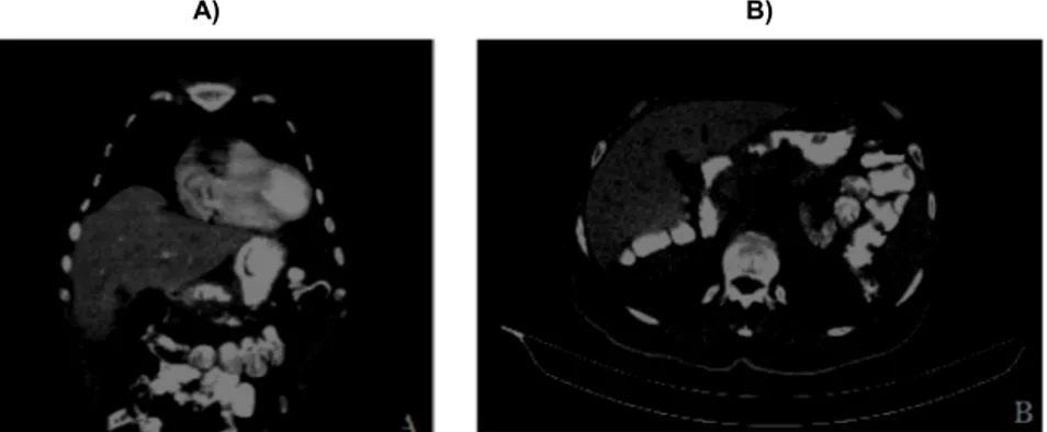 Figure 1: Photograph of abdominal computer tomography, shows the gastric Wall thickness.(A,B)