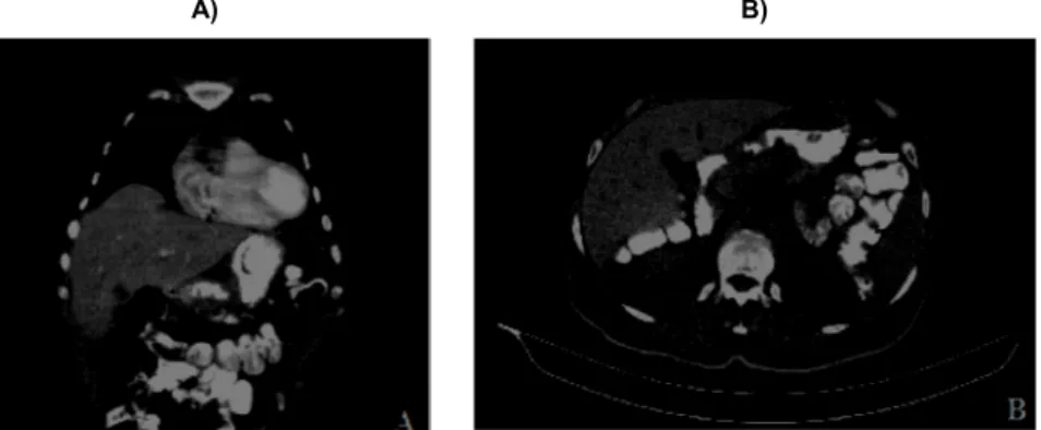 Figure 1: Photograph of abdominal computer tomography, shows the gastric Wall thickness.(A,B)