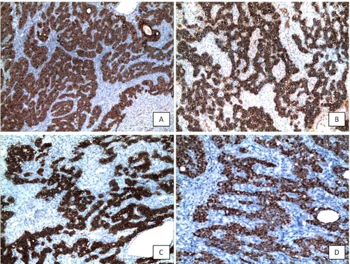 Figure 2: Tumour cells show strong and diffuse positivity with pancytokeratin (A), epithelial membrane antigen (B), cytokeratin 7 (C) and estrogene receptor (D) (x10, x10, x10, x20)