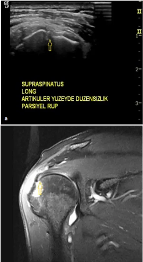Şekil 1: Ultrasonografi imajında (a) suprapinatus tendon distal kesimde tam kat yırtık ile 