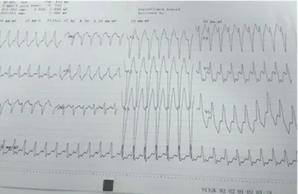 Figure 1: Electrocardiogram of the patient on admission revealed a wide   QRS tachycardia