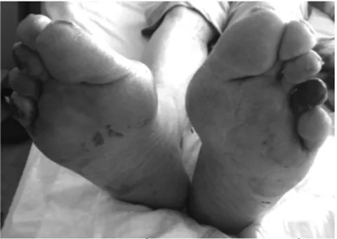 Figure 1: Left 4t h  toe and right 3 rd  and 