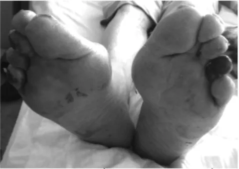Figure 1: Left 4t h  toe and right 3 rd  and 