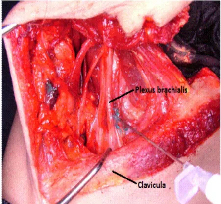 Şekil 2: Plexus brachialis, pars supraclavicularis   sol taraf (orjinal) 