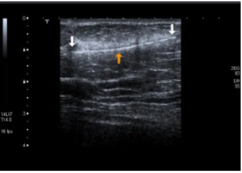 Figure 1: A hyperechoic linear object within 