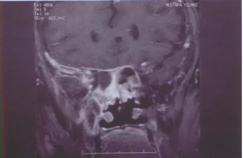 Figure 1: Soft tissue increased of maxillary, sphenoid and ethmoid sinus and contrasten-