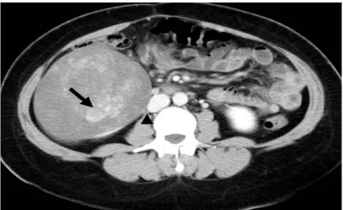 Figure 1: On contrast enhanced axial CT scan, a renal mass with smooth contours and