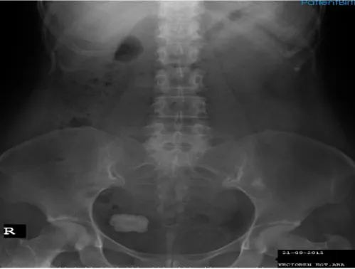 Figure 2: Stone at the base part of the bladder with an posterior acoustic shadow. 