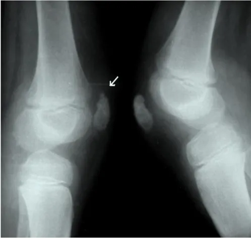 Figure 1: Fragmentation at superior pole of patella. There was no complaints at left knee 