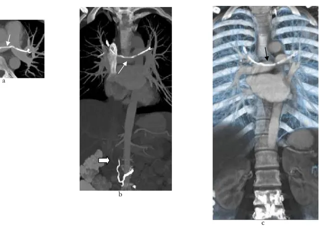 Şekil 3.  Aksiyal MIP (a), 2D koronal reformat (b) ve 3D volüm rendering (c) görüntülerde, ana pulmoner arterler içerisinde arterleri  katederek üst lob arterlerine uzanan kolye şeklinde hiperdens sement materyali görülüyor (ok)
