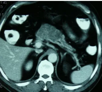 Figure 2. MRI showed hypointense multicystic 