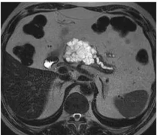 Figure 3. MRI showed hyperintense lesion with thin septations and dilated pancreatic duct on T2W sequence