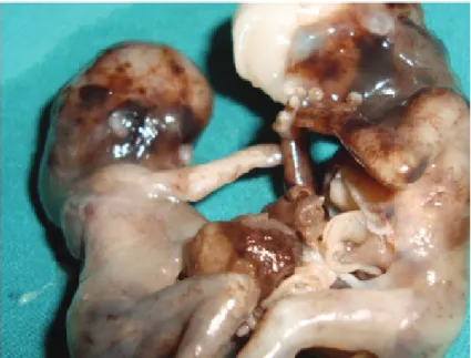 Figure 2:  Conjoined twins after termination. 