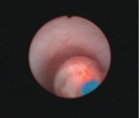 Figure 3. IVU and CT urography reveals a right distal ureteral filling defect (arrows) 