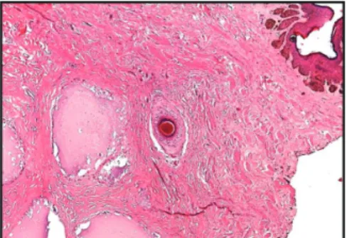 figure 5: Calcium deposits partially lined 