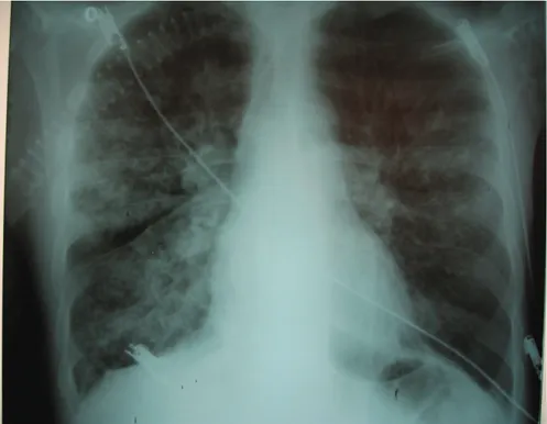 Şekil 1: Tedavi öncesi P-A akciğer grafisi 