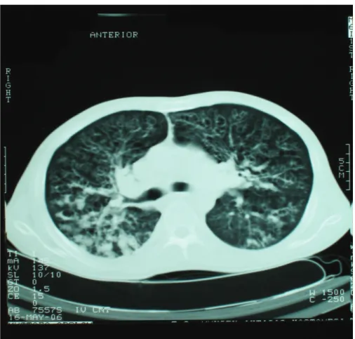 Şekil 4 : Tedavi sonrası bilgisayarlı tomografi görüntüsü
