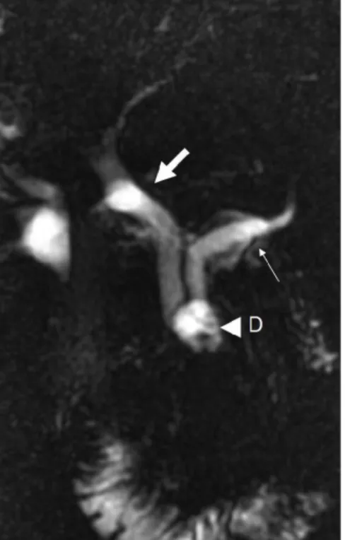 Figure 3. Thick slab MRCP image reveals 