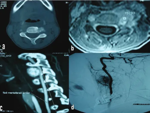 Figure 3: Postoperative 3D reconstruction  CT showing total excision.