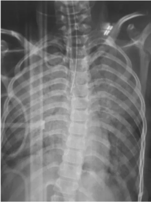 Şekil 1: Hastanın akciğer grafisinde bilateral  akciğer alanlarında diffuz ödem ile uyumlu  konsolidasyon alanları.