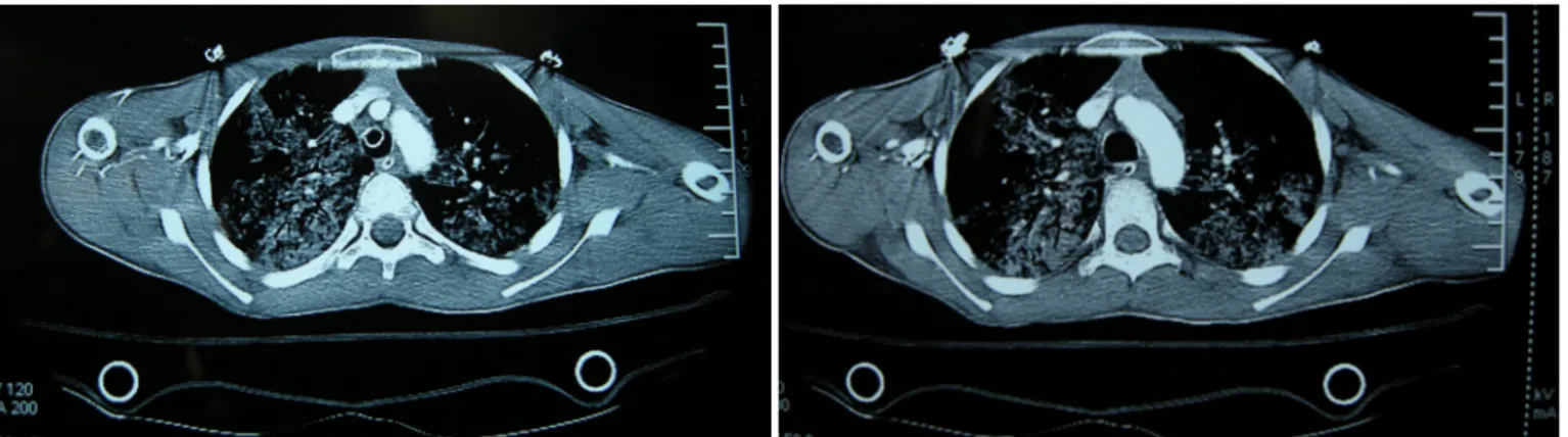 Şekil 4: Hastanın toraks tomografisi. Her iki akciğerde yaygın buzlu cam dansitesi ve alveolar hemaroji 