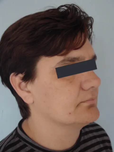 Şekil 3: Hastanın sol oblik postoperatif  görüntüsü