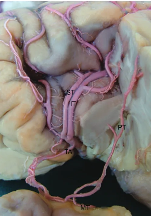 Şekil 1: Bir sol hemisferde temporal arterden çıkan PT ve MT kortikal dalları ( ST: superior trank, IT: inferior 