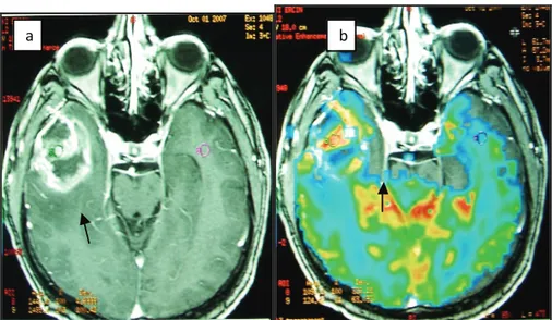 Şekil 3: Elli dört yaşındaki erkek hastanın sağ temporal lobunda glioblastoma multiforme