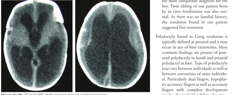 Figure 1: Feet of the patient. The feet display bifid toes and partial subcutaneous syndactyly.