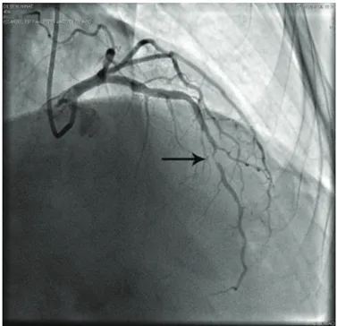 Figure 2: Significant stenosis in the LAD of Case 1 with coronary 