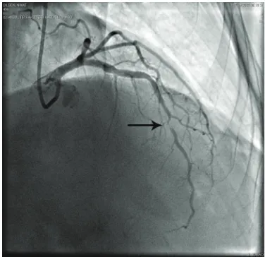 Figure 2: Significant stenosis in the LAD of Case 1 with coronary 