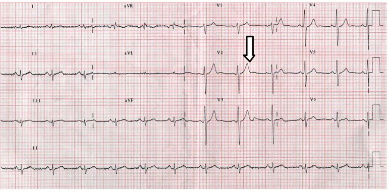 Figure 4: MSCT of Case 2. Cx totaly occluded (thick arrow), a signifi-