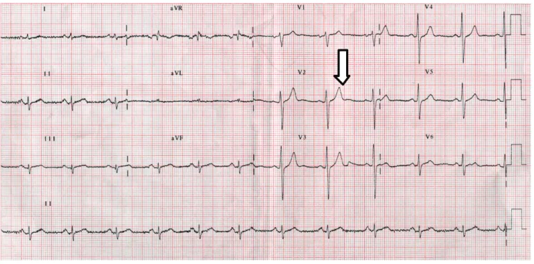 Figure 4: MSCT of Case 2. Cx totaly occluded (thick arrow), a signifi-